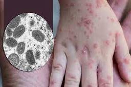 انتقال ویروس آبله میمونی از انسان به انسان بسیار نادر و بعید است