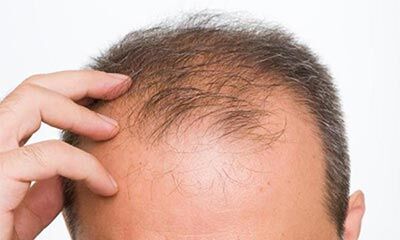 تاثیر رژیم غذایی پرچرب بر نازک شدن و ریزش مو 