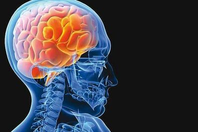 هر 5 دقیقه یک ایرانی سکته مغزی می‌کند