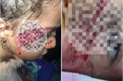 حمله سگ‌های ولگرد ‌به دختر ۵ ساله تبریزی
