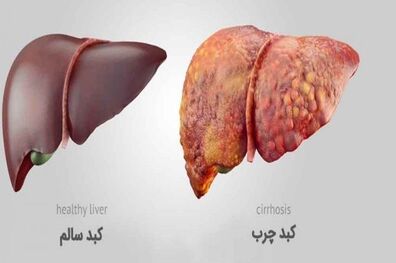 چه عواملی کبد چرب ایجاد می‌کنند؟
