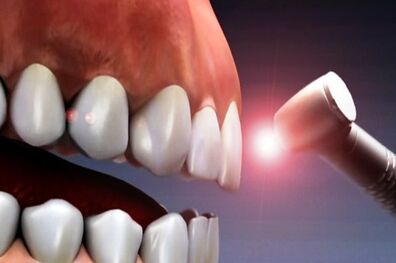 تشخیص به موقع حفره های دندانی با فناوری مادون قرمز امکان پذیر شد