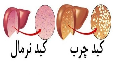 کبد چگونه چرب می شود؟ 