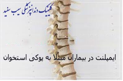 ایمپلنت دندان و پوکی استخوان