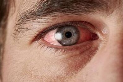 اگر در بهار دچار قرمزی چشم می‌شوید این خوراکی‌ها را نخورید