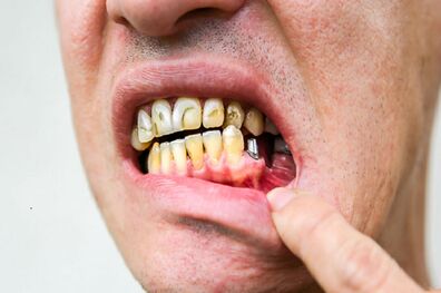 راه‌های کاهش پوسیدگی دندان
